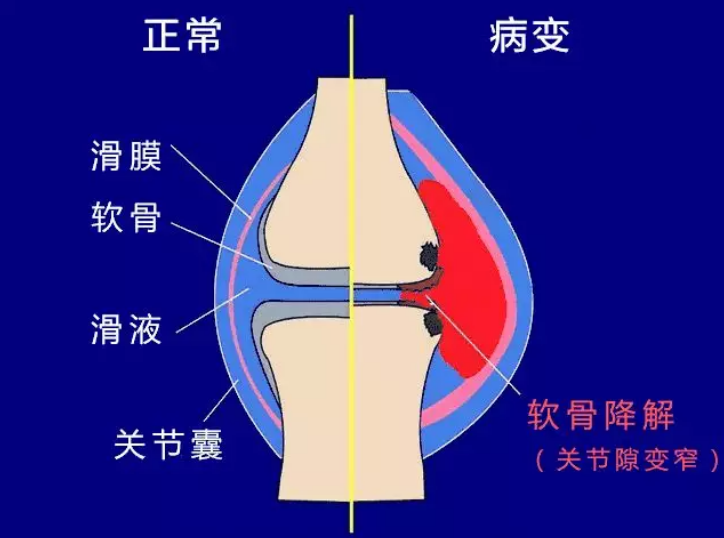 膝蓋缺痛跑步后不痛了_跑步后膝蓋痛缺什么_膝蓋跑步后疼痛需不需要治療