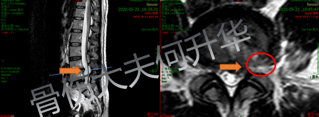 腰椎間盤突出能扭腰嗎_腰椎間盤突出扭腰好嗎_椎間盤突出扭腰