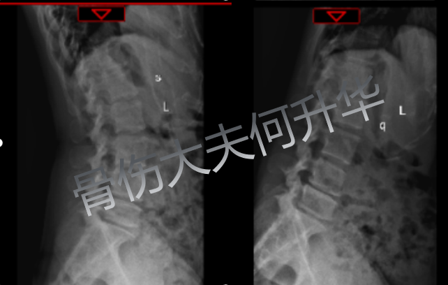 椎間盤突出扭腰_腰椎間盤突出扭腰好嗎_腰椎間盤突出能扭腰嗎