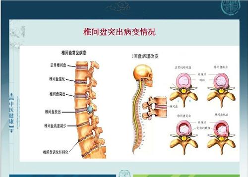 pg棋牌 腰椎間盤突出做什么運(yùn)動(dòng)最好？