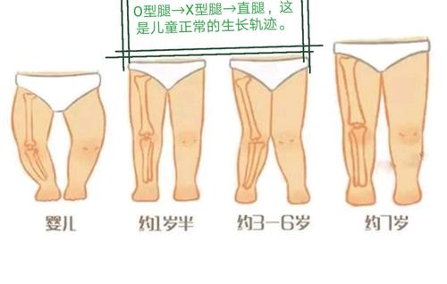 小孩小腿彎曲的正常圖_腿彎的小孩_兒童腿彎矯正