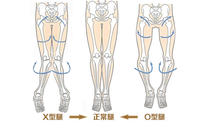 小孩小腿彎曲的正常圖_兒童腿彎矯正_腿彎的小孩