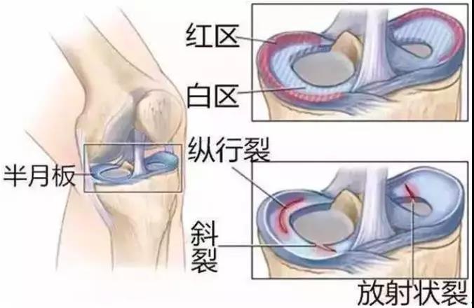 交叉韌帶康復(fù)訓(xùn)練進(jìn)度_交叉韌帶康復(fù)科一天多少錢_前交叉韌帶康復(fù)訓(xùn)練圖