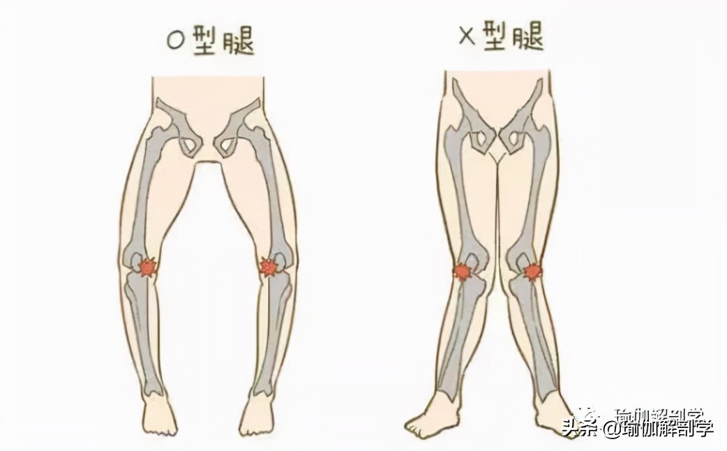 瑜伽腿型矯正_瑜伽能改善腿形嗎_改善x型腿的瑜伽