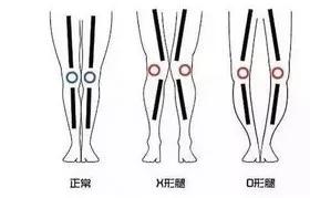 pg電子麻將胡了 如何用瑜伽矯正 O 型腿（收藏級）