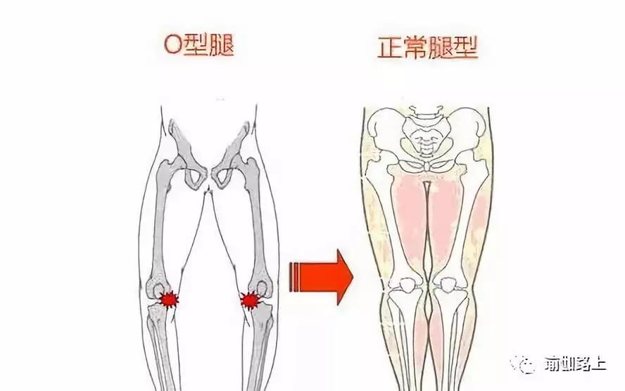 瑜伽改善腿型動(dòng)作_改善x型腿的瑜伽_瑜伽腿型矯正